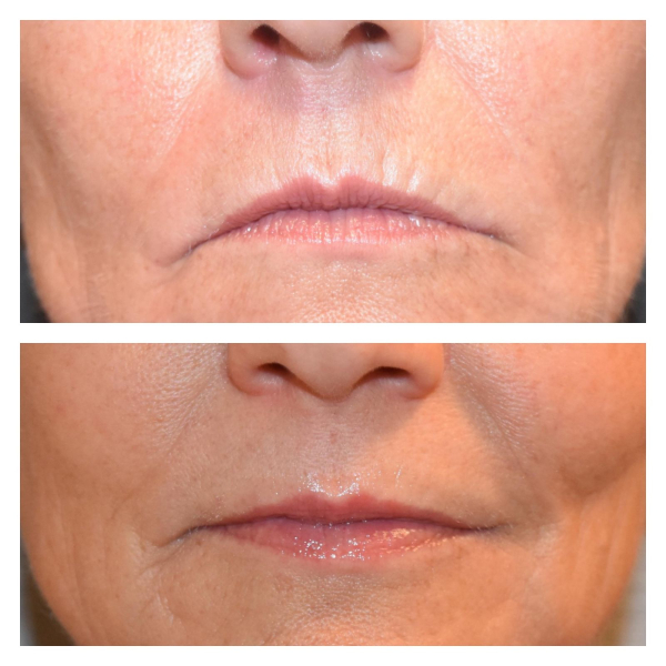 RF microneedling before and after images